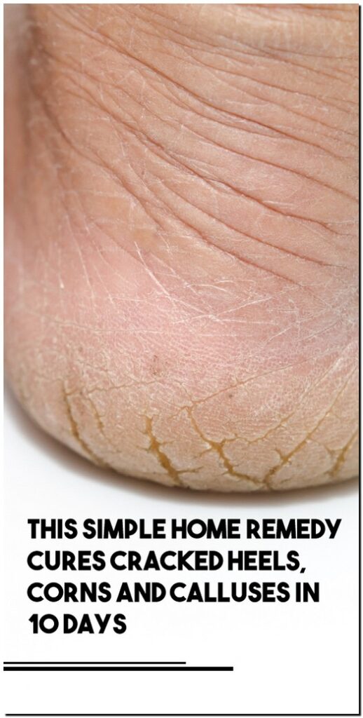 This Simple Home Remedy Cures Cracked Heels, Corns And Calluses In 10 Days