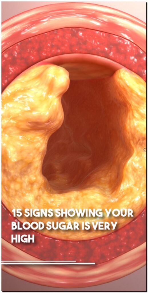 15 Signs Showing Your Blood Sugar Is Very High